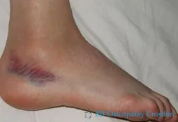 Foot and ankle sprains
