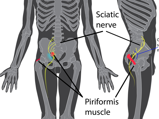 Siatica Treatments